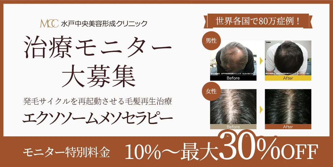 治療モニター大募集 発毛サイクルを再起動させる毛髪再生治療エクソソームメソセラピー