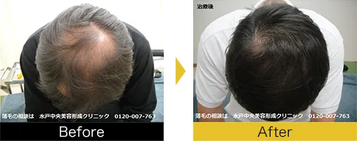 他院で効果を得られなかった方も発毛を実感されています。