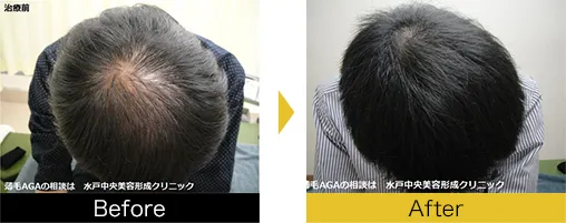 他院で効果を得られなかった方も発毛を実感されています。