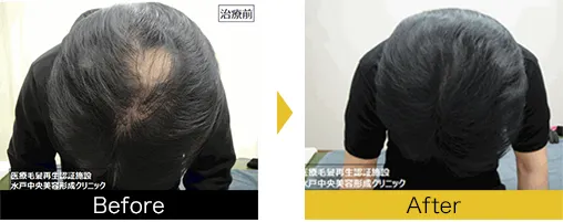 他院で効果を得られなかった方も発毛を実感されています。