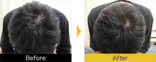他院で効果を得られなかった方も発毛を実感されています。