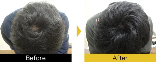 他院で効果を得られなかった方も発毛を実感されています。