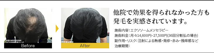 他院で効果を得られなかった方も発毛を実感されています。