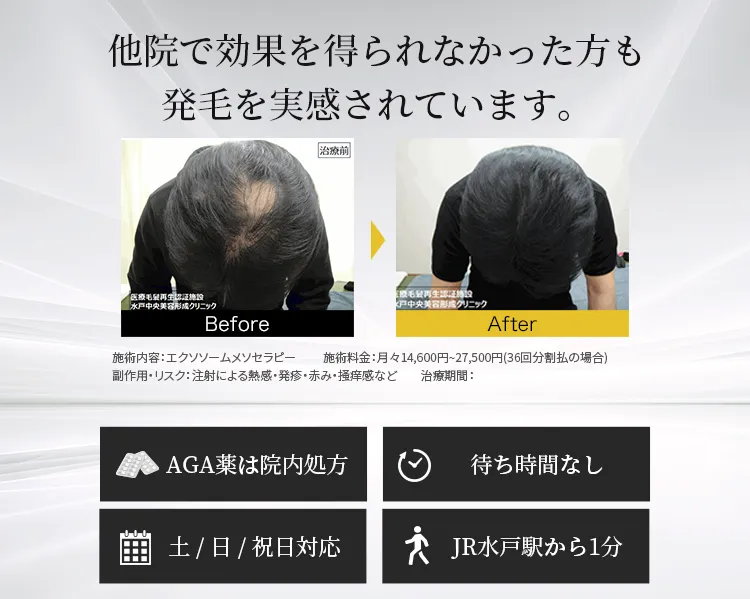 他院で効果を得られなかった方も発毛を実感されています。AGA薬は院内処方 待ち時間なし 土 / 日 / 祝日対応 JR水戸駅から1分