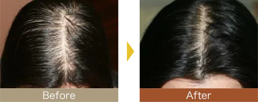 他院で効果を得られなかった方も発毛を実感されています。