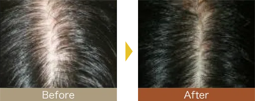 他院で効果を得られなかった方も発毛を実感されています。